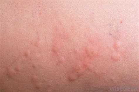 What are Viral Hives? (with pictures)