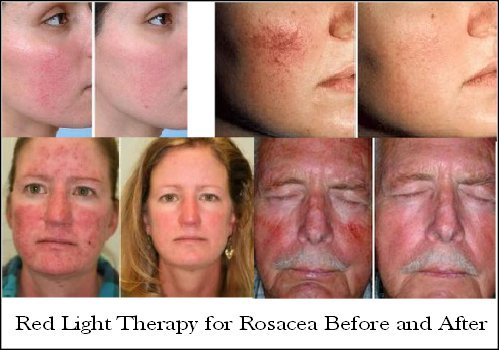Does Red Light Therapy Really Work? — SunScape Tanning Studios