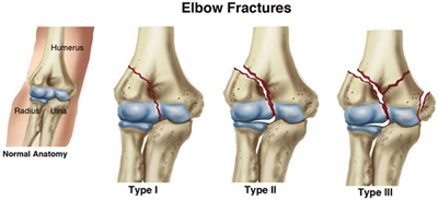 Elbow Fracture - MoveForwardPT.com