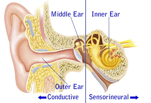 Treatment For Sensorineural Hearing Loss