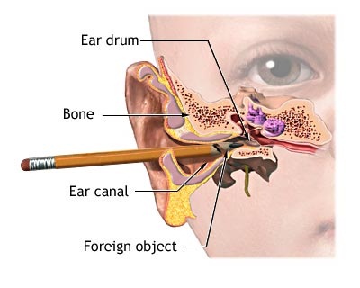 Ear Canal Infection - Causes, Symptoms, Treatment ...