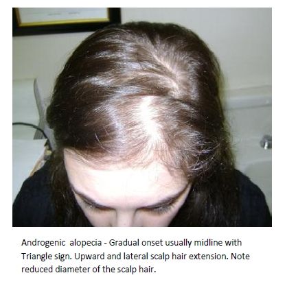 Thinning hair due to the effects of male hormones ...