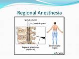 Regional Anesthesia 