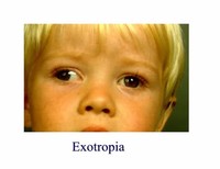 Exotropia Intermittent Exotropia