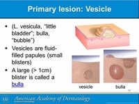 Blisters Small Blisters are Also Called Vesicles