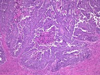 Uterine Serous Carcinoma