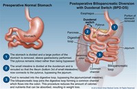 Duodenal Switch With Biliopancreatic Diversion