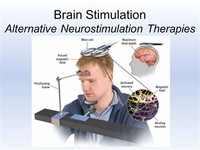 Brain Stimulation Therapy