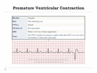 Premature Ventricular Contractions (PVCs)