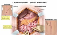 Laparoscopic Removal of Adhesions (Scar Tissue) 