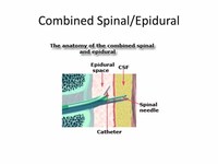 Combined General and Epidural Anesthesia
