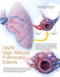 High-Altitude Pulmonary Edema