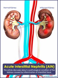 Interstitial Nephritis