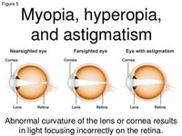 Hyperopic Astigmatism