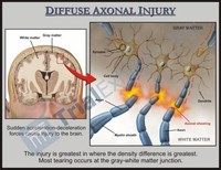 Diffuse Axonal Injury 