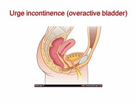 Urge Incontinence due to an Overactive Bladder