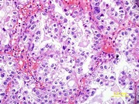 Clear Cell Carcinoma