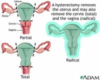 Hysterectomy: 