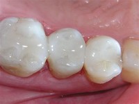 Composite (Tooth-Coloured) 