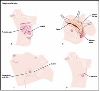 Total (Simple) Mastectomy