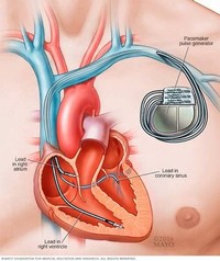 Biventricular Pacemaker