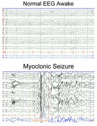 Myoclonic Seizures