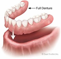 Traditional/Conventional Complete Full Dentures