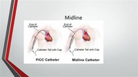 Midline Catheter
