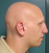 Alopecia Totalis and Alopecia Universalis