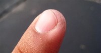 Ingrown Nails