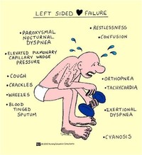Left-Sided Heart Failure