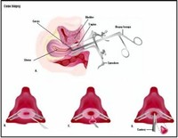 Cervical (Cone) Biopsy