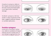 Nystagmus (Involuntary Rapid eye Movements)