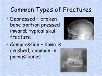 Depressed Bone Pressed Inward (Skull Fracture)
