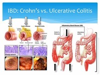 Crohn's Colitis