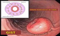 Gastrointestinal Stromal Tumours (GIST)