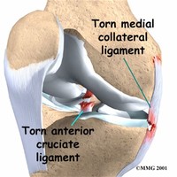 Collateral Ligament Injuries