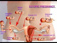 Tubal Pregnancy