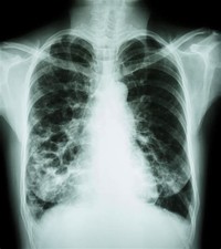 Cystic Fibrosis/Bronchiectasis