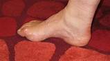 High Arch Foot or Pes Cavus
