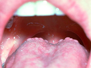 Warts On Tongue | www.pixshark.com - Images Galleries With ...