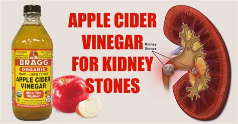 5 Ways To Use Apple Cider Vinegar To Dissolve Kidney Stones
