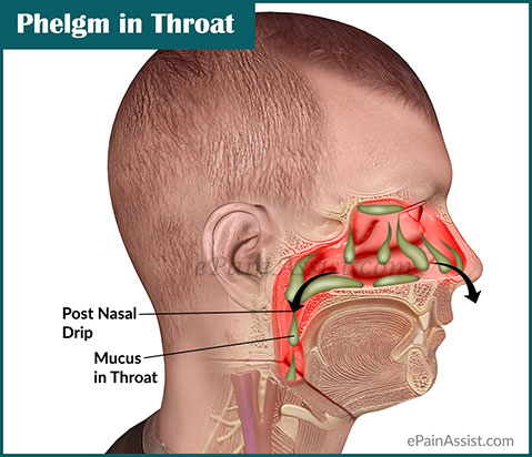 Phlegm in Throat or Mucus in Throat: Causes & Ways to Get ...