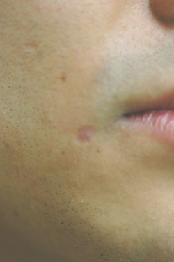 Can Laser Treatment Remove Chicken Pox Scars?