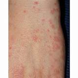 An Answer to the Medical Question: What Does Scabies Look ...