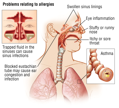 Hay Fever (Allergic Rhinitis) Guide: Causes, Symptoms and ...