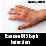 what causes staph infection - pictures, photos