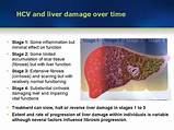 Module 3: Liver damage and course of HCV infection