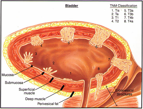 Get the Facts on Bladder Cancer - Katelaris Urology ...
