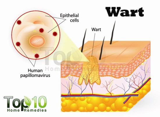 Home Remedies for Warts | Top 10 Home Remedies